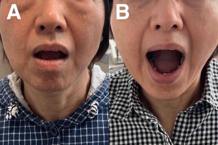 Chiropractic therapy for TMJ disease, results.